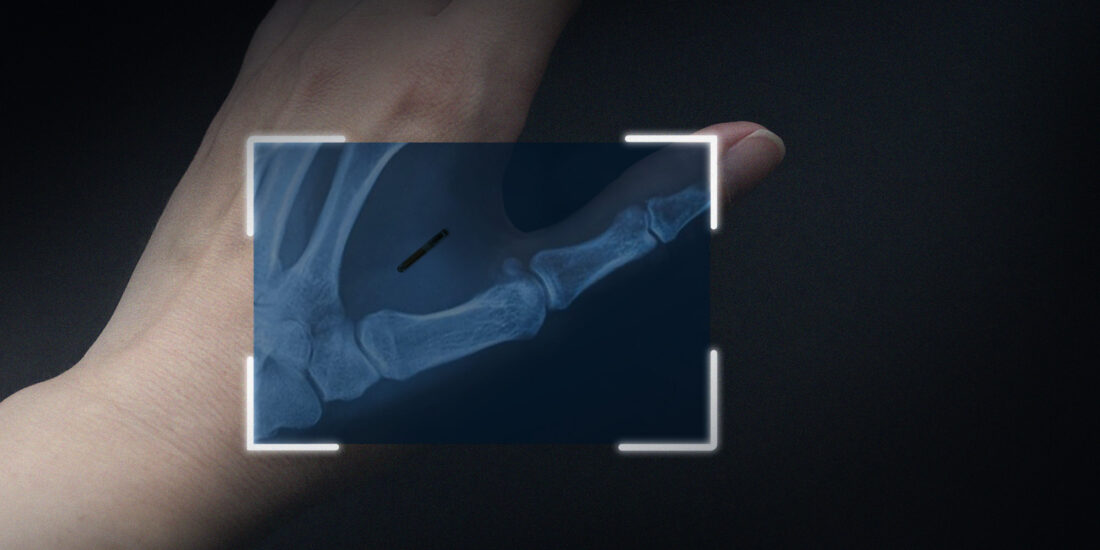 Implanted Microchip in Hand